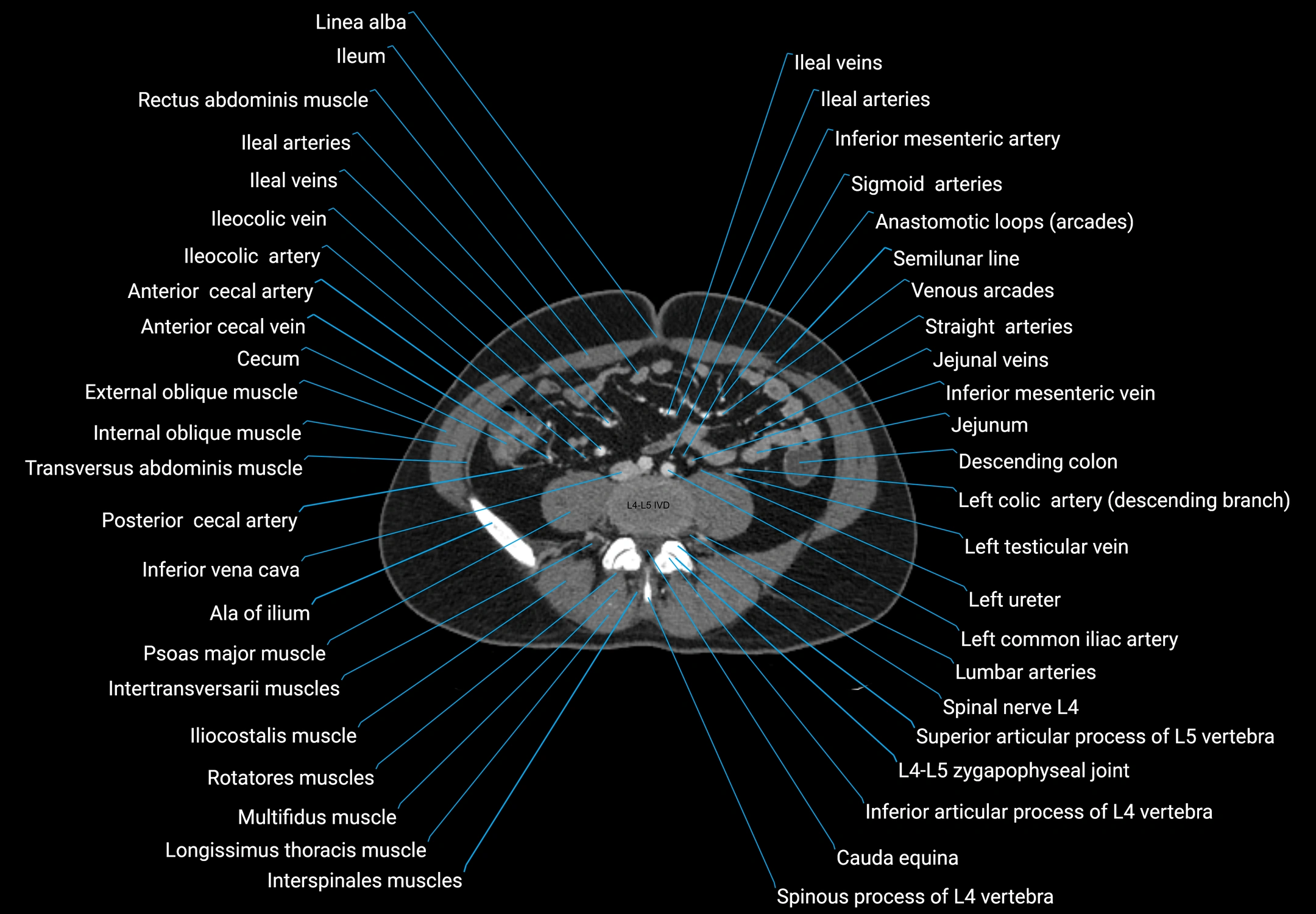 CT male pelvis axial cross sectional anatomy labelled radiology image -00117.webp